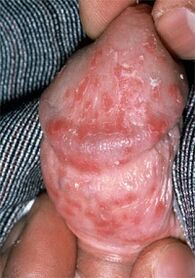 penile discharge due to thrush